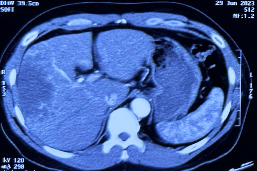 Hình ảnh chụp chiếu của một bệnh nhân mắc ung thư đường mật di căn xa (Ảnh: BS).